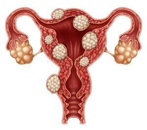 Resources & Research Sites on Fibroids