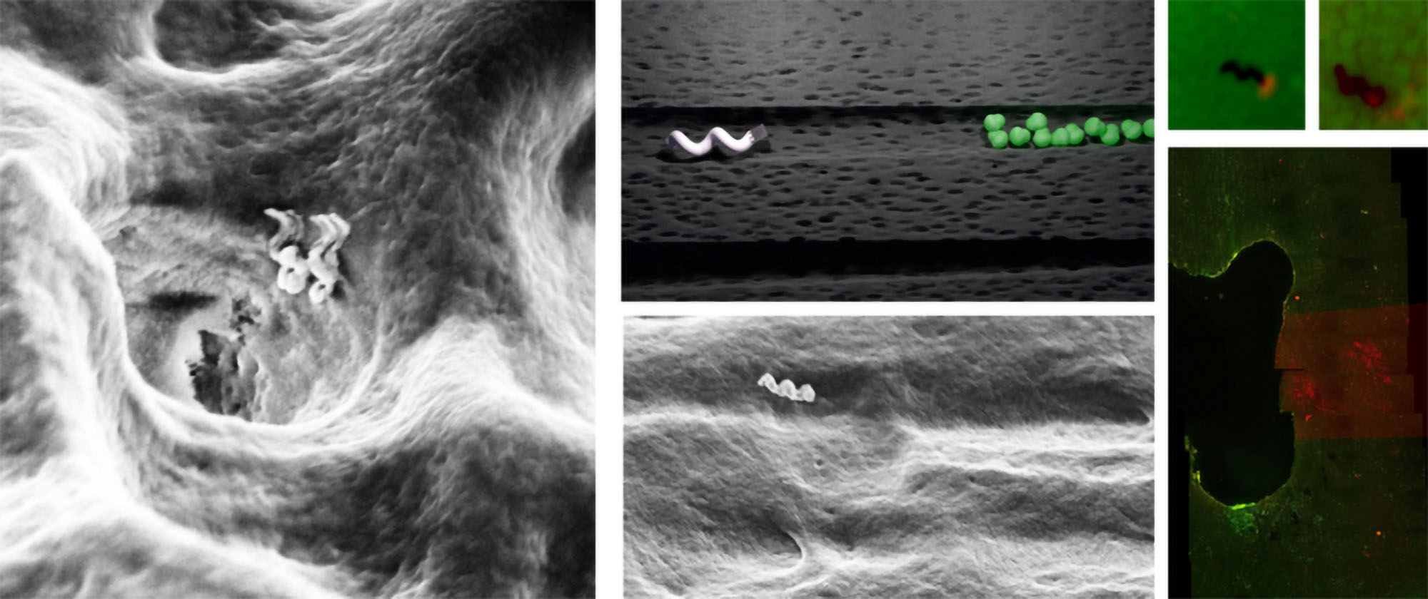 Left: Nanobots entering a dentinal tubule. Centre top and bottom: Schematic representation and electron microscope image of nanobot moving through dentinal tubule to reach bacterial colony. Right: How locally induced heat from nanobot can kill bacteria. Live bacteria are green and dead bacteria are red. Bottom right shows band where targeted treatment has been done in human teeth. (Theranautilus/Zenger)