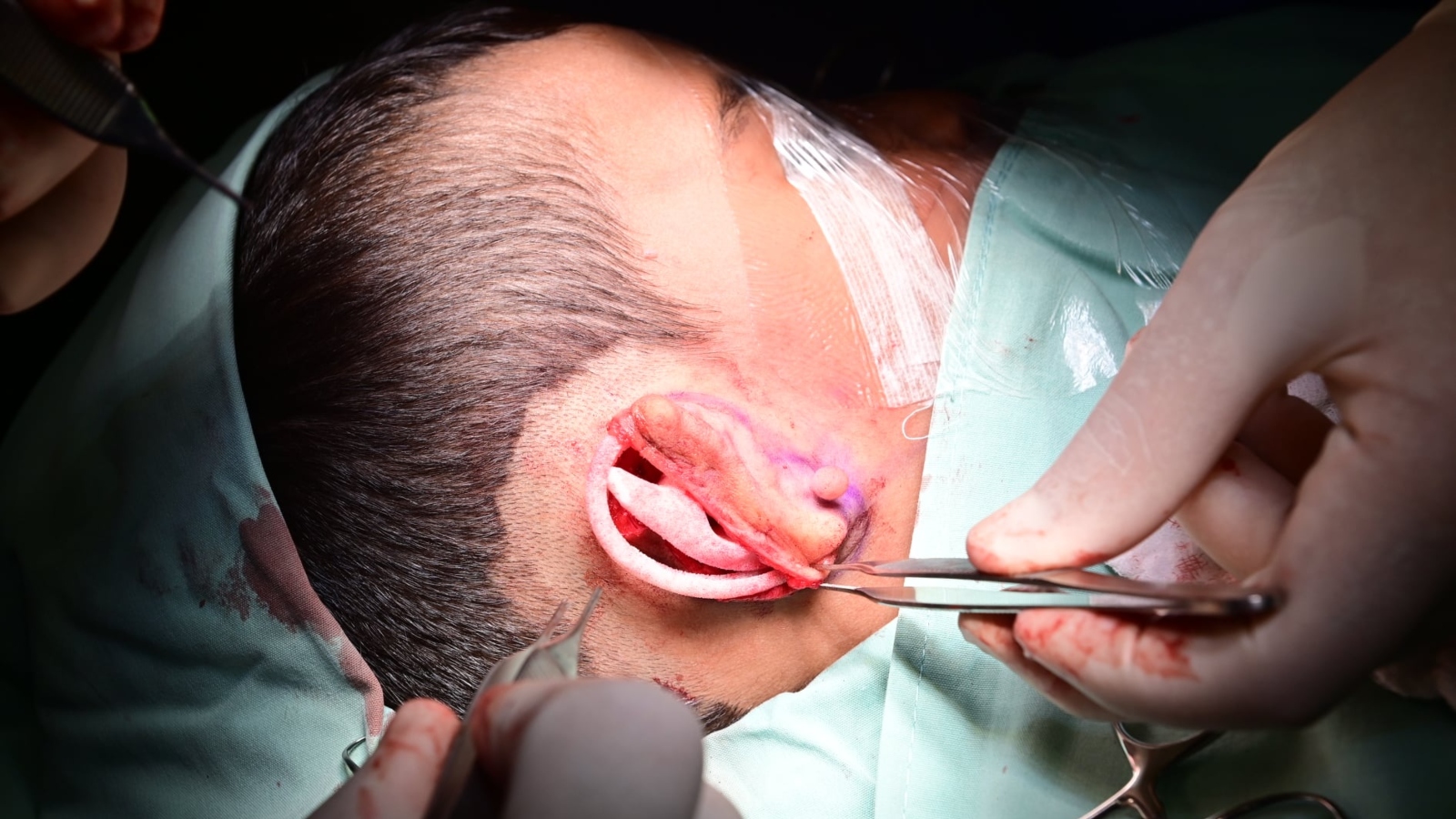 A 3D-printed prosthetic ear being attached to a six-year-old boy. (Galilee Medical Center)