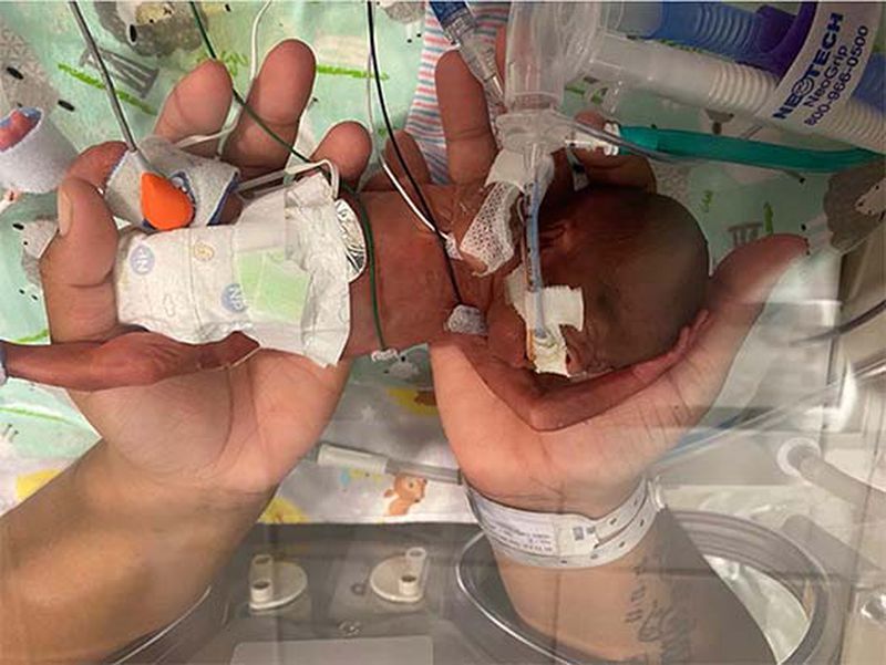 Curtis Means, Alabama boy weighing less than a pound at birth, is world’s most premature surviving baby