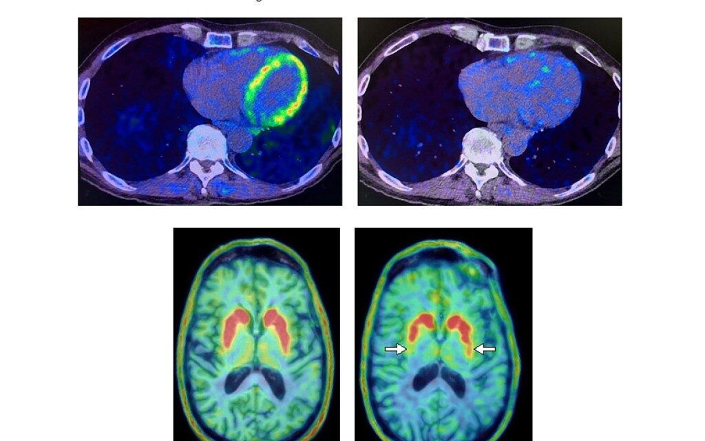 Revolutionary study explores use of unique heart scans for early detection of dementia disorders