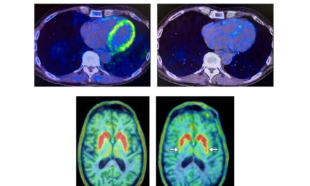 Revolutionary study explores use of unique heart scans for early detection of dementia disorders