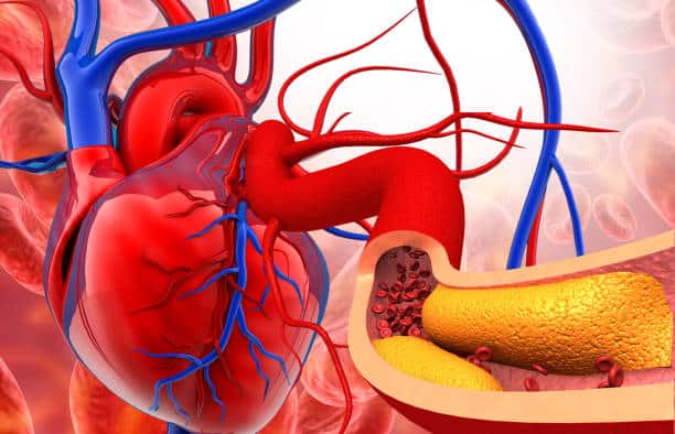 8 Signs You’re Living With Clogged Arteries