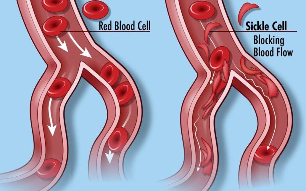 Addressing sickle cell disease: The importance of genetic counseling