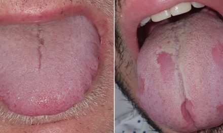 ‘COVID Tongue’: What to Know About This Rare COVID-19 Symptom