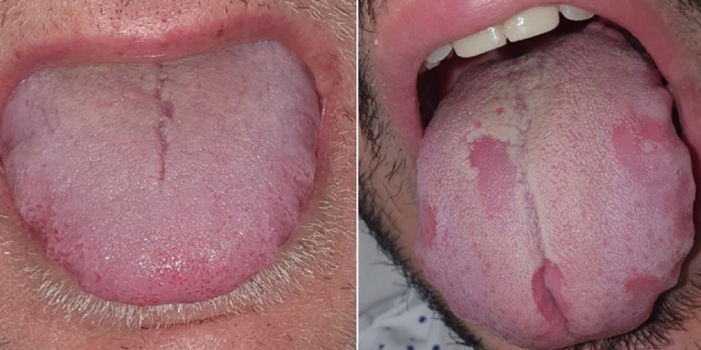 ‘COVID Tongue’: What to Know About This Rare COVID-19 Symptom