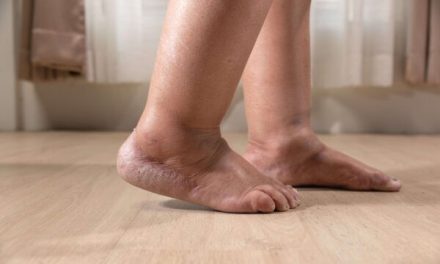 Edema: A Hidden Health Risk for African American