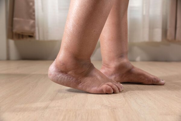 Edema: A Hidden Health Risk for African American