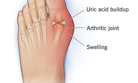 Breaking the Cycle: Why Gout Keeps Coming Back—And How to Stop It