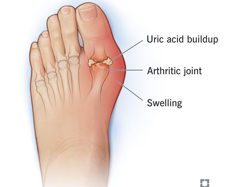 Breaking the Cycle: Why Gout Keeps Coming Back—And How to Stop It