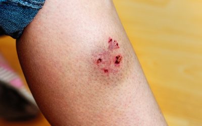 Rabies Still a Public Health Threat in Alabama, Officials Warn