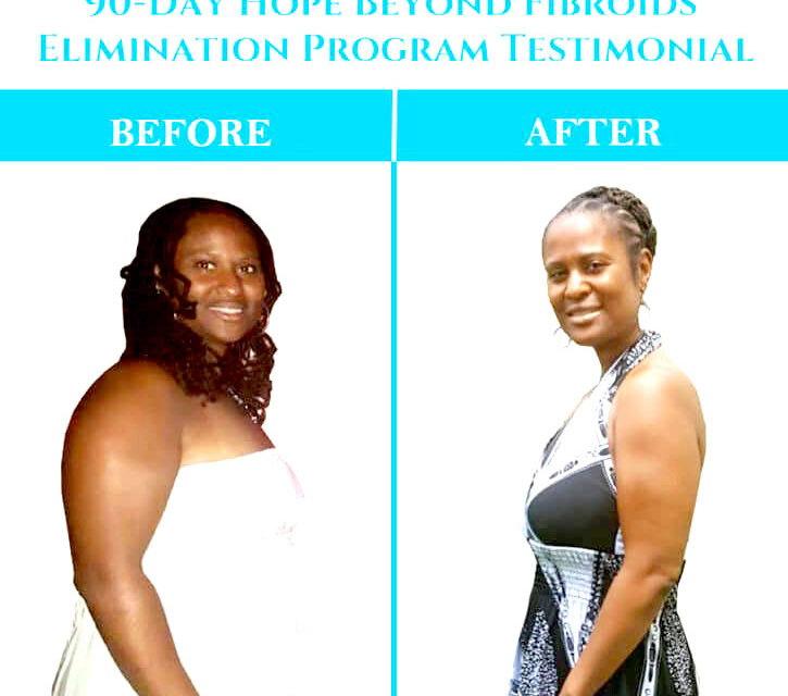 How One Woman Eliminated 50 Fibroids Without Surgery